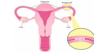 Important Role of Fallopian Tube during Pregnancy